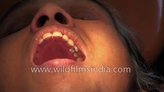 Root Canal treatment in India [upl. by Torras]