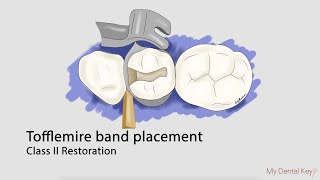 Tofflemire matrix band placement  My Dental Key [upl. by Ag]