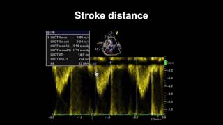 Echocardiogram from the Patient Compared with That from a Normal Control  NEJM [upl. by Rimma]