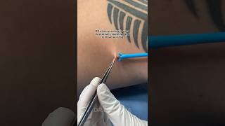 Skin Tag Removal in under 10 MINUTES  Dr Medispa [upl. by Yelnoc]