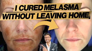 Melasma Treatment At Home Expert Doctors 3 Easy Steps  before and after [upl. by Lowenstern707]