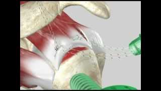 Arthroscopic Rotator Cuff Repair [upl. by Craddock]