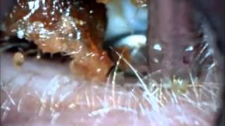 Ear wax removal Hopi Candle gone wrong [upl. by Notterb]