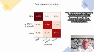 AI analysis of MJM detects SBx in OSA patients  Video abstract ID 320664 [upl. by Asylem927]