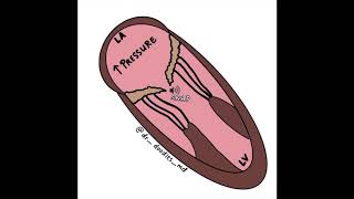 Mitral Stenosis Opening Click [upl. by Suzann633]