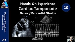 HandsOn Experience 10 Cardiac Tamponade Pleural  Pericardial Effusion [upl. by Rimidalv]