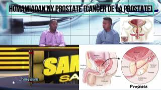 HOMAMIADANNY PROSTATE CANCER DE LA PROSTATE MG [upl. by Smith]