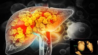 Cirrhosis of Liver Full Details liverdetox liverhealth cirrhosis diseasecure treatment [upl. by Knapp]