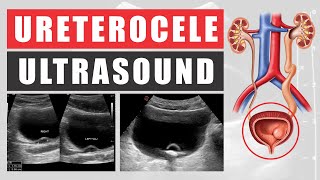 Ureterocele and Ultrasound [upl. by Aliuqet]