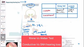 Conductive vs sensorineural hearing loss neurology 159 First Aid USMLE Step 1 in UrduHindi [upl. by Bud]