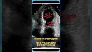 Takotsubo Cardiomyopathy Echo REBELEM FOAMus MedEd TakotsuboCardioMyopathy [upl. by Bosson]