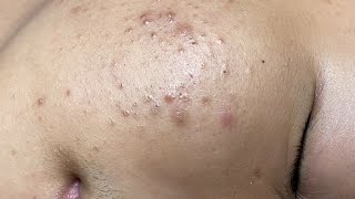 ACNE TREATMENT VU QUYNH MI Blackheads On Boy Face 2024 [upl. by Brett]