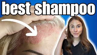 BEST Shampoo For Psoriasis  Dermatologist Recommended [upl. by Irpac]