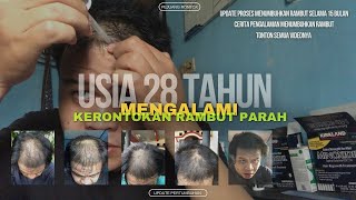 USIA MASIH MUDA RAMBUT SUDAH MULAI RONTOK SAMPAI BOTAK [upl. by Eillim]