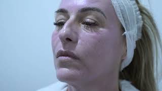 Radiofrecuencia Fraccionada Facial en Sevilla [upl. by Arfihs687]