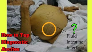 Ascitic tapping Procedure steps Ascites tapping complication  Ascites diagnostic tests [upl. by Kaczer]