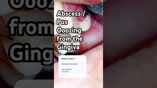 How Pus Comes Out From Gingiva abscess dentalabscess gingivitis pus viralshorts dentalshorts [upl. by Ydnamron899]