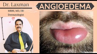 What Is Angioedema  Angioedema  Causes N Treatment  Allergy  Dermatology [upl. by Bohaty]