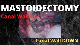 068 Canal Wall UP amp Canal Wall DOWN Mastoidectomy mastoid surgery hearingimpaired [upl. by Hooke]