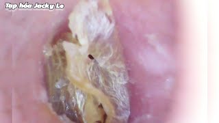 Ear Wax Removal 133 Thick Earwax Sticks To The Skin And Is Very Itchy  Ear Cleaning ASMR [upl. by Romulus837]