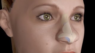 Bulbous Large Nasal Tip Nose Job Rhinoplasty [upl. by Soisanahta]