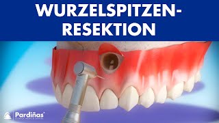 Wurzelspitzenresektion © [upl. by Nahtanaj]