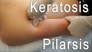 Keratosis Pilaris Clear  Brilliant Treatment FT Eric Smith  BLUSH Beverly Hills [upl. by Joann]