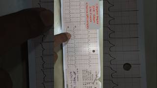 SupraVentricular TachycardiaDr Sameer Shah [upl. by Crescin]