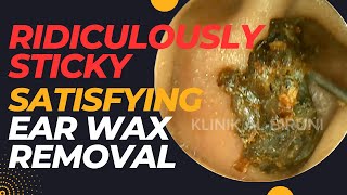 RIDICULOUSLY Sticky Satisfying Ear Wax Removal [upl. by Ennair65]