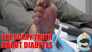 THE ANSWER TO FIX HIS DAMAGED NERVES DIABETIC NEUROPATHY PART 2  FOOT HEALTH MONTH 2018 22 [upl. by Sirap]