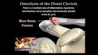 Osteolysis Of The Distal Clavicle  Everything You Need To Know  Dr Nabil Ebraheim [upl. by Annotahs]