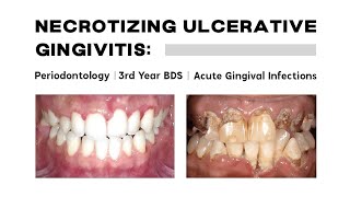 Necrotizing Ulcerative Gingivitis  Periodontology Acute gingival infections BDS [upl. by Onavlis]