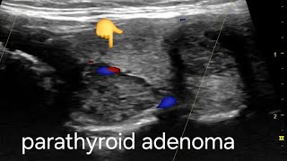 Large Parathyroid adenoma ultrasound and color Doppler video [upl. by Blanchard]