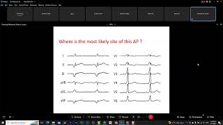 Narrow complex tachycardia Dr Mohamed Adam [upl. by Dalt]