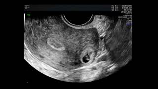 Intramural twin pregnancy after invitro fertilization [upl. by Snoddy]