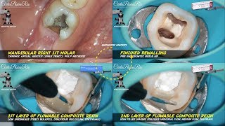 rewalling pre endodontic build up palfique bulk flow tokuyama essence matrix mandibular molar [upl. by Aihpos]