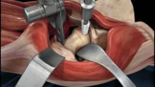 Direct Anterior Approach Hip Replacement [upl. by Tallbott655]