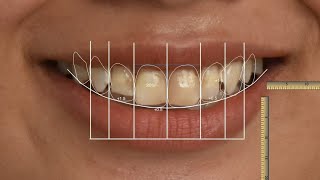 Orthodontic Smile Transformation OST Digital Smile Design [upl. by Anaujal]