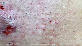 Big Cystic Acne Blackheads Extraction Blackheads amp Milia Whiteheads Removal Pimple Popping [upl. by Lyn]