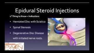 5 Things to Know About Epidural Steroid Injections 602 5076550 [upl. by Ainola]