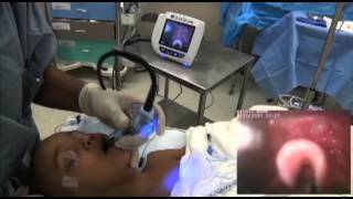 GlideScope Pediatric Airway Rounds Case Study 3 year old Umbilical Hernia Repair [upl. by Nahamas607]