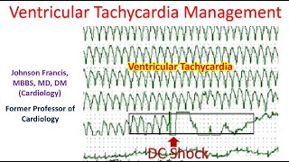 Ventricular Tachycardia Management [upl. by Odnalro]