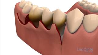 Scaling and Root Planing Therapy AMSR [upl. by Oicapot]