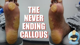 EXTREME UNBELIEVABLE NEVER ENDING THICKEST FOOT CALLUSCALLOUS REMOVAL [upl. by Goggin127]