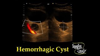 Adnexal Hemorrhagic Cyst  Ultrasound  Case 33 [upl. by Alphonsa]