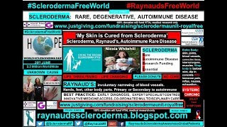 My skin is cured from Scleroderma Nicola Whitehill December 2016 [upl. by New]