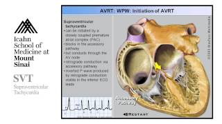 Supra Ventricular Tachycardia [upl. by Naerda399]