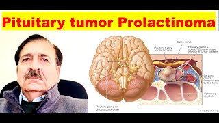 Prolactinoma Signs Symptoms diagnosis and Treatment Lectures by Dr Alamzeb [upl. by Nazario]