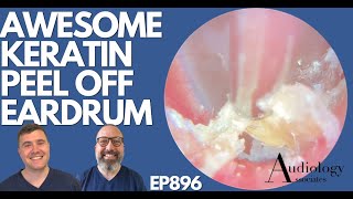 AWESOME KERATIN PEEL OFF EARDRUM  EP896 [upl. by Ericksen]