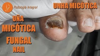 Uña micótica  Fungal nail  Unha micótica Podología Integral [upl. by Lleinad]